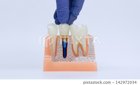 Dental implant crown placement demonstration with gloved hand installing prosthetic tooth on anatomical jaw model Dental implant crown placement demonstration with gloved hand installing prosthetic tooth on anatomical jaw model 142972034