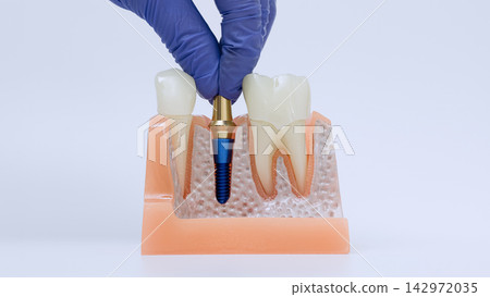 Dental implantology procedure showing prosthetic abutment installation into titanium implant on realistic anatomical jaw model Dental implantology procedure showing prosthetic abutment installation into titanium implant on realistic anatomical jaw model 142972035