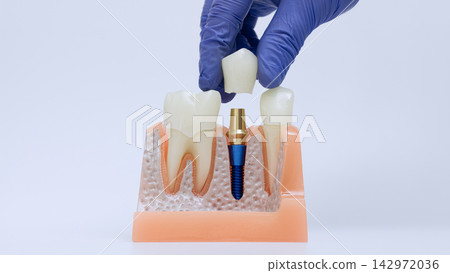 Dental implant crown placement with gloved hand positioning prosthetic tooth over abutment on anatomical jaw model Dental implant crown placement with gloved hand positioning prosthetic tooth over abutment on anatomical jaw model 142972036