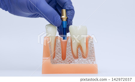 Dental implantology procedure concept showing titanium implant positioned over jaw bone model between natural teeth 142972037