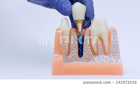 Dental implant restoration procedure showing prosthetic crown and abutment installation onto titanium implant model Dental implant restoration procedure showing prosthetic crown and abutment installation onto titanium implant model 142972038