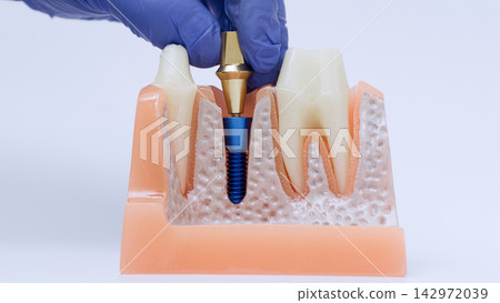 Dental implant abutment placement with gloved hand positioning prosthetic connector into titanium implant on anatomical jaw model Dental implant abutment placement with gloved hand positioning prosthetic connector into titanium implant on anatomical jaw model 142972039
