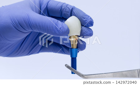 Close up dental implant system with prosthetic crown, abutment and titanium screw held by dentist in medical glove 142972040