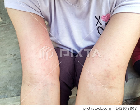 Close up of small red bumps on young skin, pediatric dermatology symptoms, irritation from heat or contact dermatitis, childhood health issue. 142978808
