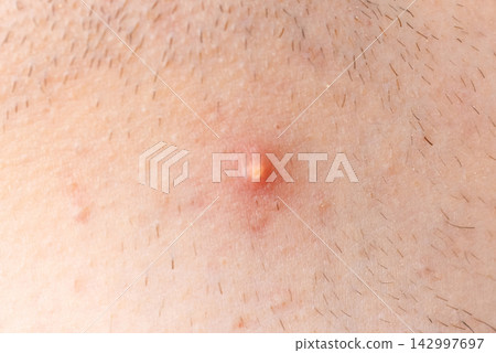 Acne on face skin, macro texture, skincare and dermatology problem Acne on face skin, macro texture, skincare and dermatology problem 142997697