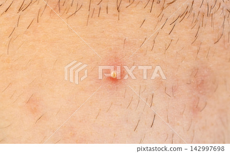 Acne on face skin, macro texture, skincare and dermatology problem 142997698