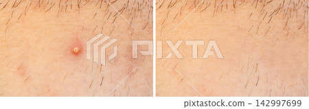 Acne on face skin, macro texture, skincare and dermatology problem Acne on face skin, macro texture, skincare and dermatology problem 142997699