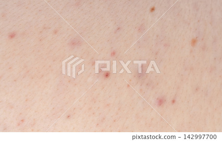 Acne on face skin, macro texture, skincare and dermatology problem Acne on face skin, macro texture, skincare and dermatology problem 142997700