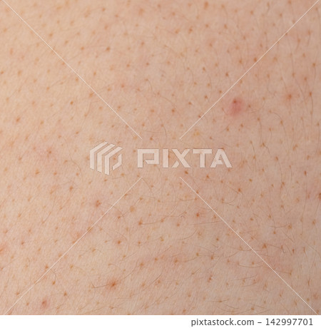 Acne on face skin, macro texture, skincare and dermatology problem Acne on face skin, macro texture, skincare and dermatology problem 142997701
