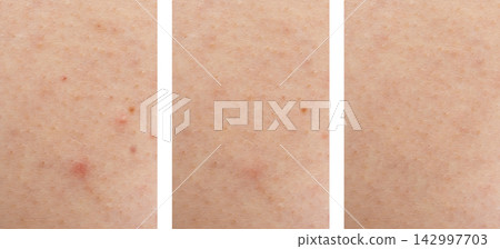 Acne on face skin, macro texture, skincare and dermatology problem Acne on face skin, macro texture, skincare and dermatology problem 142997703