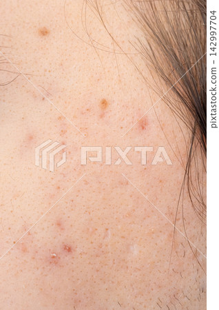 Acne on face skin, macro texture, skincare and dermatology problem Acne on face skin, macro texture, skincare and dermatology problem 142997704