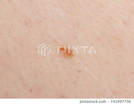 Acne on face skin, macro texture, skincare and dermatology problem 142997736