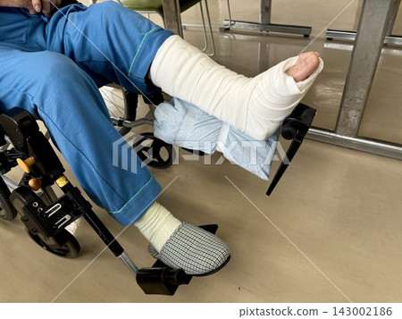 A 70-year-old woman's fractured leg A 70-year-old woman's fractured leg 143002186
