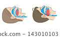 Illustration of sleep apnea syndrome and normal breathing 143010103