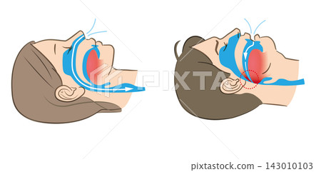 睡眠呼吸中止症和正常呼吸的圖示 睡眠呼吸中止症和正常呼吸的圖示 143010103