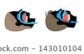 Illustration of sleep apnea syndrome and normal breathing 143010104