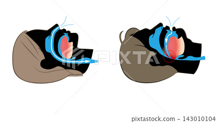 Illustration of sleep apnea syndrome and normal breathing Illustration of sleep apnea syndrome and normal breathing 143010104