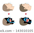 Illustration of sleep apnea syndrome and normal breathing 143010105