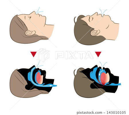 睡眠呼吸中止症和正常呼吸的圖示 睡眠呼吸中止症和正常呼吸的圖示 143010105