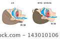 Illustration of sleep apnea syndrome and normal breathing 143010106