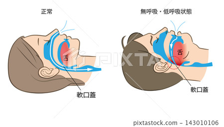Illustration of sleep apnea syndrome and normal breathing Illustration of sleep apnea syndrome and normal breathing 143010106