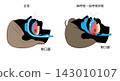 Illustration of sleep apnea syndrome and normal breathing 143010107