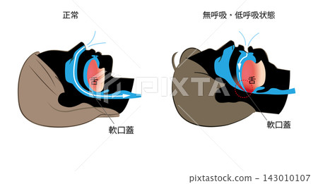 睡眠呼吸中止症和正常呼吸的圖示 睡眠呼吸中止症和正常呼吸的圖示 143010107