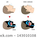 Illustration of sleep apnea syndrome and normal breathing 143010108