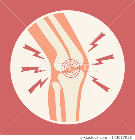 Knee Joint Pain and Inflammation. Medical Illustration. Knee Joint Pain and Inflammation. Medical Illustration. 143017958