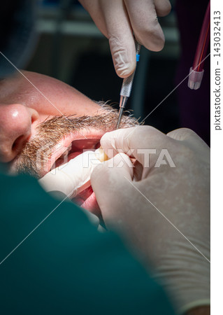 Dental restoration try-in during implant dentistry treatment in a clinic Dental restoration try-in during implant dentistry treatment in a clinic 143032413