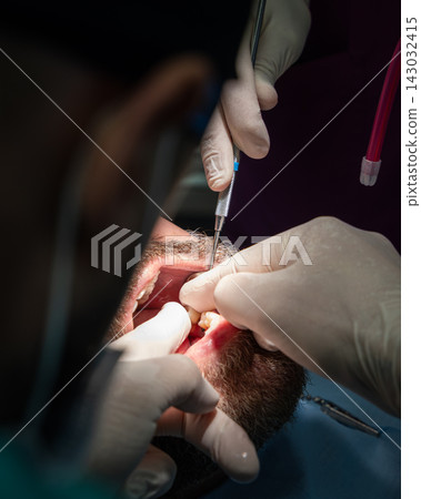 Dentist seating a tooth-shaped implant restoration during patient treatment Dentist seating a tooth-shaped implant restoration during patient treatment 143032415
