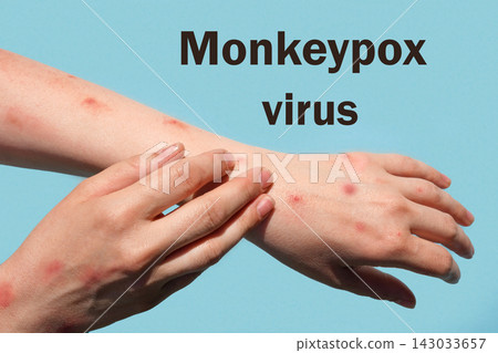 Phrase MONKEYPOX VIRUS on blue background and Patient with Monkey Pox. Monkeypox new disease dangerous over the world. Painful rash, red spots blisters. Close up human hands with Health problem Phrase MONKEYPOX VIRUS on blue background and Patient with Monkey Pox. Monkeypox new disease dangerous over the world. Painful rash, red spots blisters. Close up human hands with Health problem 143033657