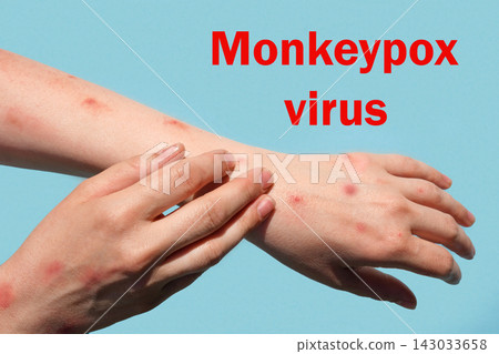 Phrase MONKEYPOX VIRUS on blue background and Patient with Monkey Pox. Monkeypox new disease dangerous over the world. Painful rash, red spots blisters. Close up human hands with Health problem 143033658