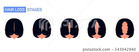 Top view of female pattern hair loss stages. Androgenetic alopecia progression in woman showing widening hair part and gradual thinning of hair on scalp. Isolated vector illustration 143042940