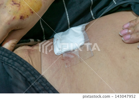Close up of surgical wound covered sterile gauze medical tape visible bruising skin showing postoperative care recovery healing Close up of surgical wound covered sterile gauze medical tape visible bruising skin showing postoperative care recovery healing 143047952