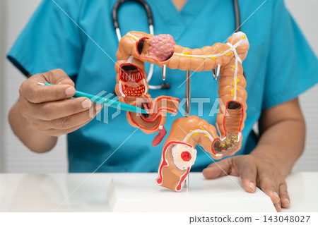 Colorectal cancer, doctor holding intestine colon human model. Colorectal cancer, doctor holding intestine colon human model. 143048027
