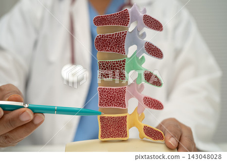 Doctor holding osteoporosis in back bone model. Doctor holding osteoporosis in back bone model. 143048028
