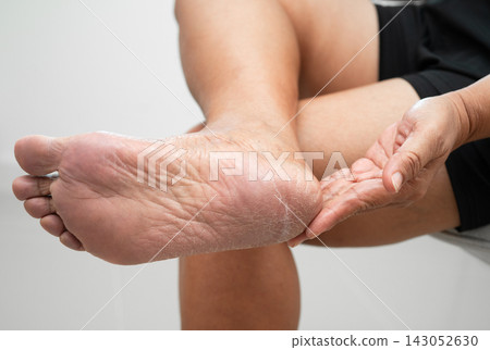 Asian woman check feet with crack and dry heel skin, Diabetic Foot. Asian woman check feet with crack and dry heel skin, Diabetic Foot. 143052630
