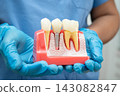 Dentist holding dental implant, artificial tooth roots into jaw, root canal of dental treatment, gum disease, teeth model for dentist. 143082847