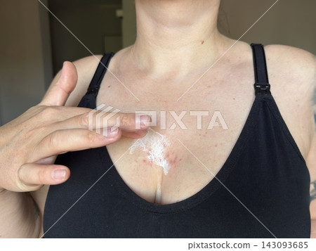 A woman applies soothing cream or ointment onto irritated red skin on her chest. This image represents skin care treatment medical ointment application and allergy relief. A woman applies soothing cream or ointment onto irritated red skin on her chest. This image represents skin care treatment medical ointment application and allergy relief. 143093685