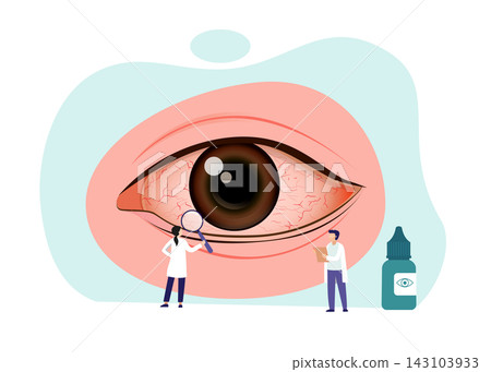 Illustration of inflammation of the inner lining of the eyelid or Conjunctivitis Illustration of inflammation of the inner lining of the eyelid or Conjunctivitis 143103933