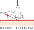 Ultrasound-guided vascular puncture ① Medical illustration of the puncture procedure using a long-axis view 143119358