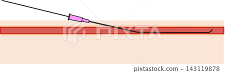 PICC置管步驟4：導絲經外鞘插入 143119878