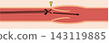 PICC insertion procedure troubleshooting: Diagram illustrating the guidewire contacting a venous valve. 143119885