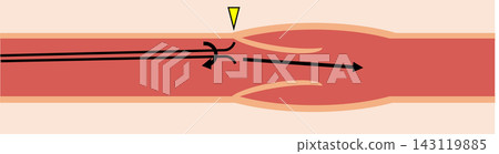 PICC insertion procedure troubleshooting: Diagram illustrating the guidewire contacting a venous valve. PICC insertion procedure troubleshooting: Diagram illustrating the guidewire contacting a venous valve. 143119885