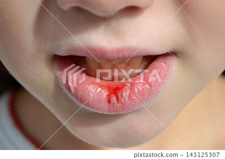 Dry and damaged lips of a girl. Close-up. Lip fissure and bleeding. Sick cracked damaged tissue. Dry lips with cracks, dry mouth, Closeup face with brittle and dry lips, dehydration High quality photo Dry and damaged lips of a girl. Close-up. Lip fissure and bleeding. Sick cracked damaged tissue. Dry lips with cracks, dry mouth, Closeup face with brittle and dry lips, dehydration High quality photo 143125307