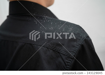 Man with dandruff on shirt at shoulder. Man with dandruff on shirt at shoulder. 143129045
