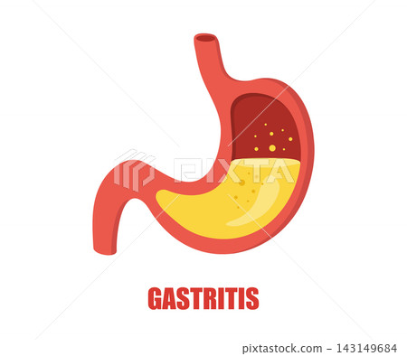Stomach diseases. Gastritis concept. Medical check up. Vector illustration in flat cartoon style Stomach diseases. Gastritis concept. Medical check up. Vector illustration in flat cartoon style 143149684