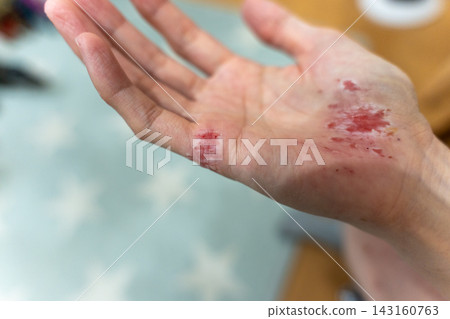 手掌擦傷的特寫照片，顯示皮膚發紅並脫皮。 143160763
