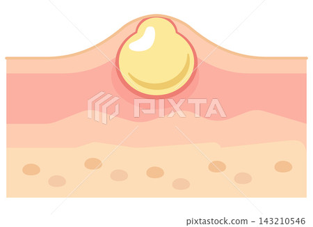 Cross-sectional view of skin structure and pustules (pus/acne) Cross-sectional view of skin structure and pustules (pus/acne) 143210546